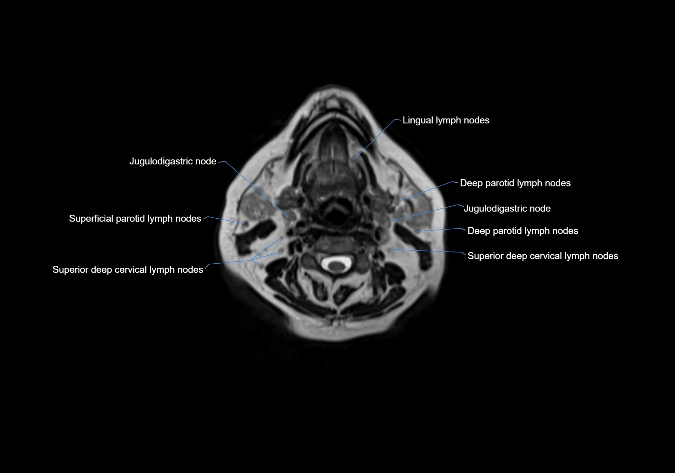 Neck axial  lymph node cross sectional MRI anatomy 3T MRI  image-img-00001-00049.webp